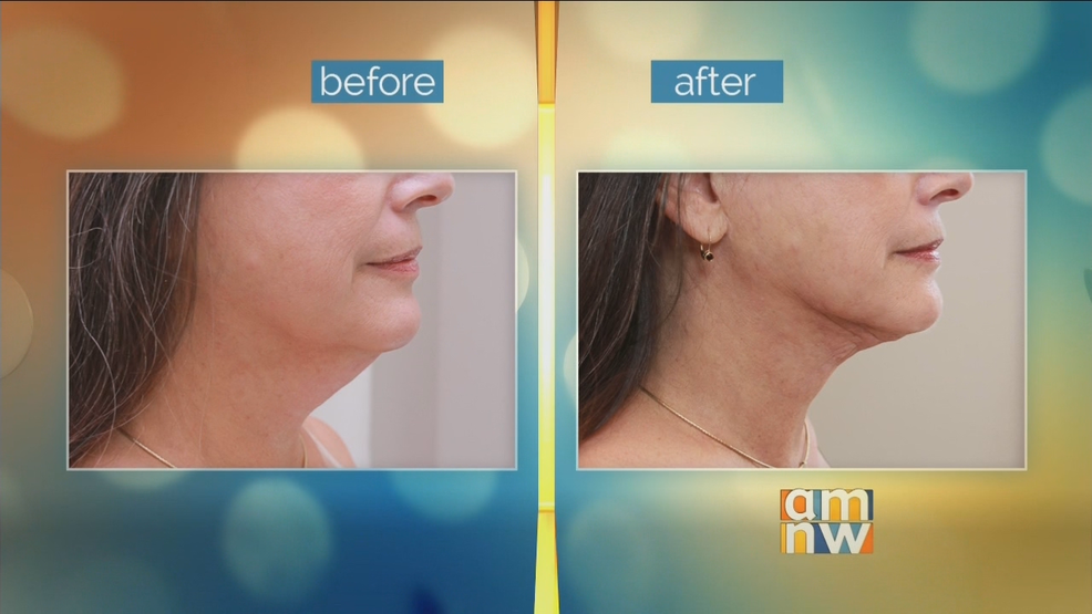 lipolift.png lipolift.png